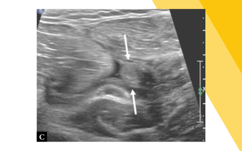 8. Evaluacion lesiones pectoral mayor ecografia tempo formacion.png